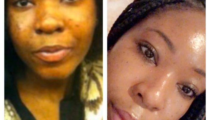 Acne & Hyperpigmentation– How I Went From That To This